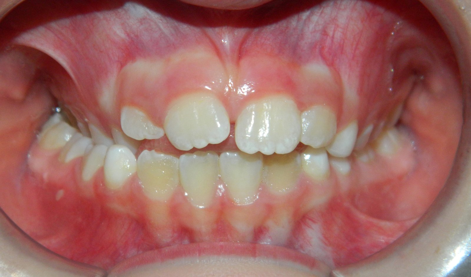 Antes