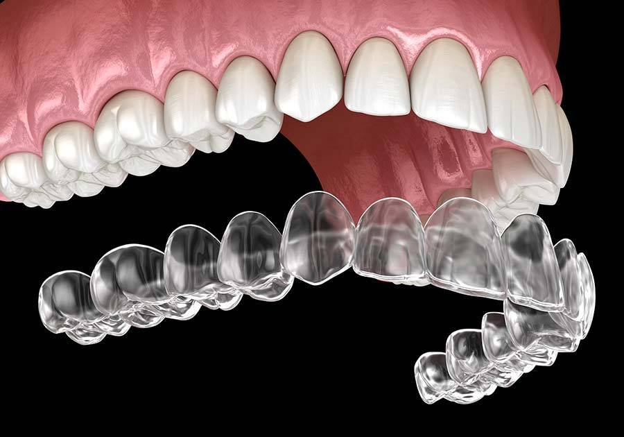 Alineadores Invisalign